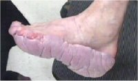 Deep lines and overgrowth of soft tissue on the soles of feet.